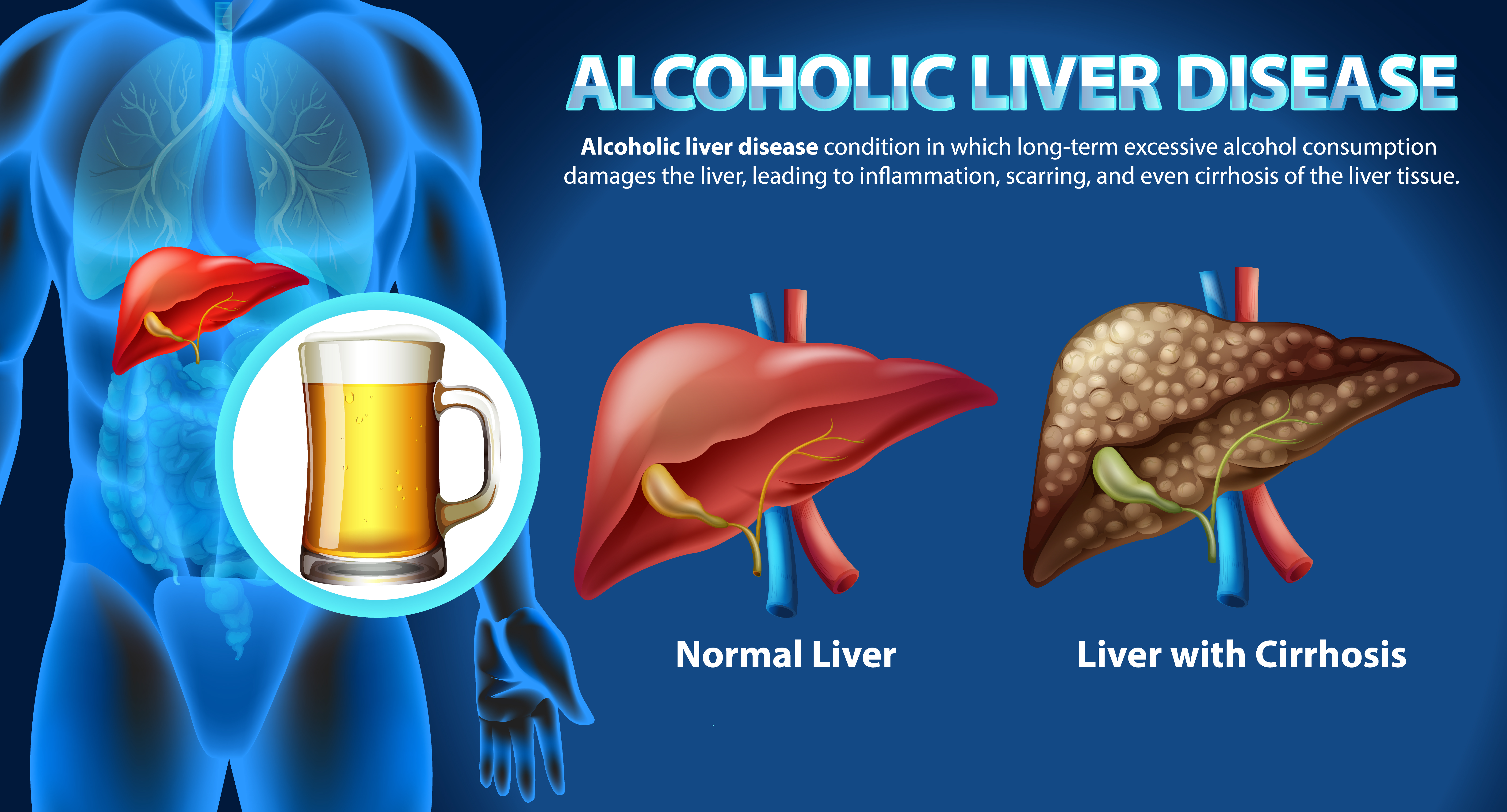 Alcoholic Liver Disease: Understanding, Prevention, and Holistic Management